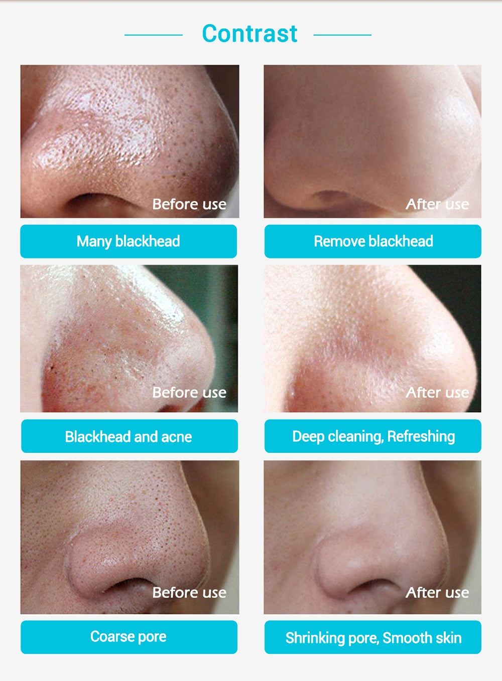 Blackhead Remover Deep Cleansing Acne Treatment